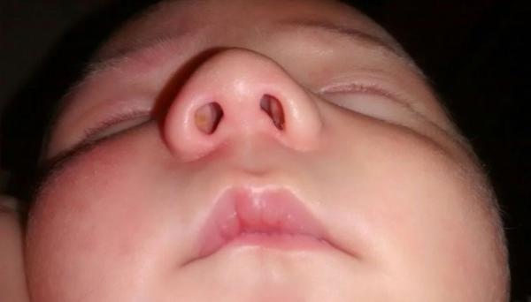انحراف بینی در نوزادان و بچه ها، علت، علائم و راه های درمان